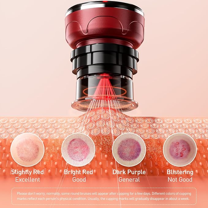 UBALANCE Cupping Kit for Massage Therapy, Cupping Therapy Set 6 Cups, Electric Smart Cupping Machine, 4 in 1 Negative Pressure Massager with 12 Modes for Fatigue Relief, Red